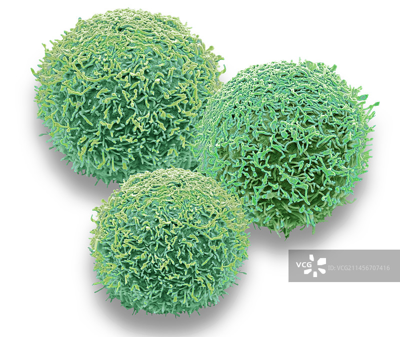 口腔癌细胞，扫描电子显微镜图片素材