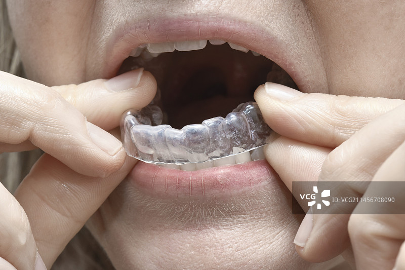 牙齿垫片保护器图片素材