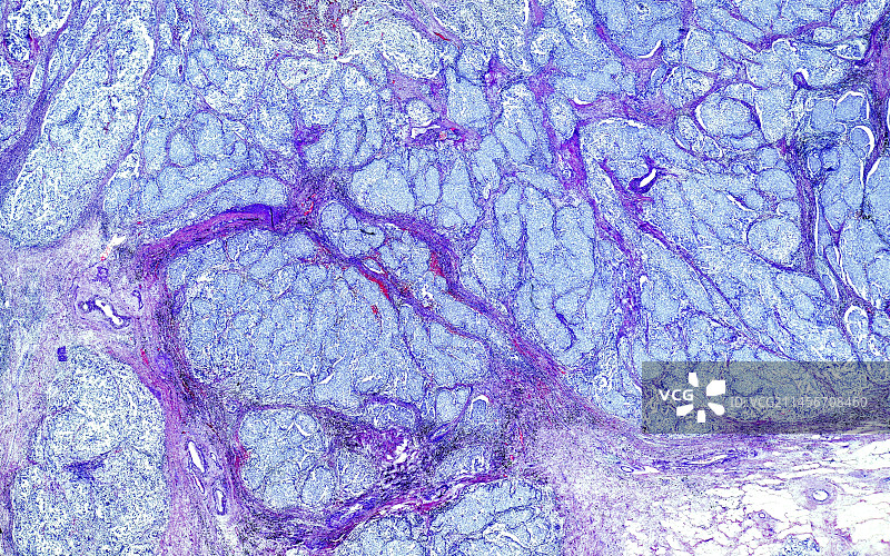乳腺导管癌光学显微照片图片素材