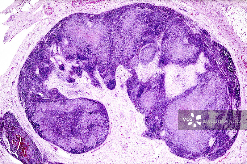 慢性霍奇金淋巴瘤显微照片图片素材