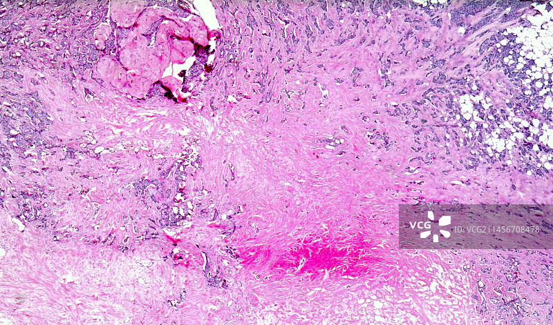 肝硬化导致乳腺癌浅显显微照片图片素材