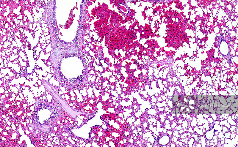 大叶性肺炎出血性水肿期显微照片图片素材
