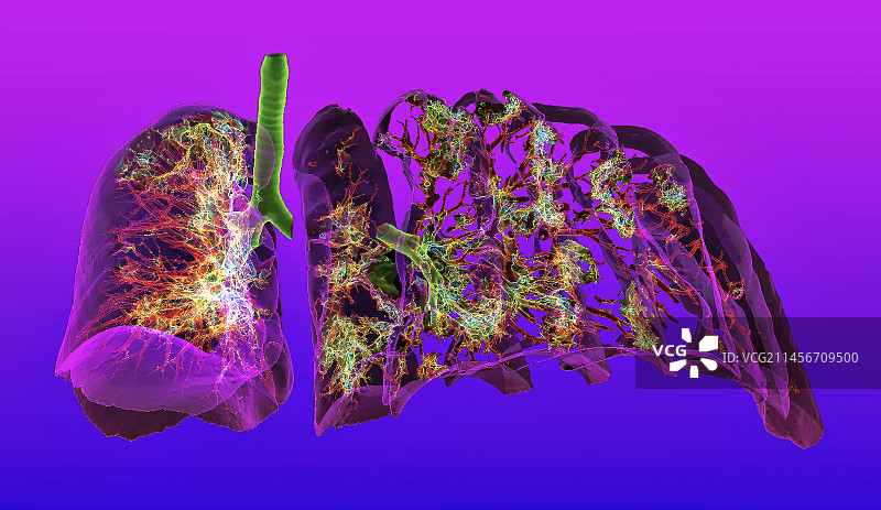 新型冠状病毒感染的非典型肺炎肺部3D CT扫描图片素材