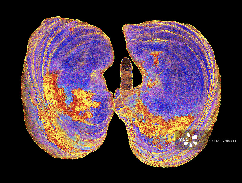 受新冠影响的肺部非典型肺炎3D CT扫描图片素材