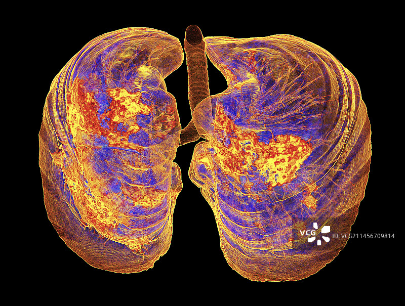 受新冠影响的肺部非典型肺炎3D CT扫描图片素材