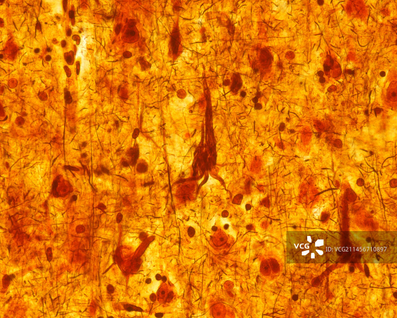 神经原纤维缠结，光学显微照片图片素材