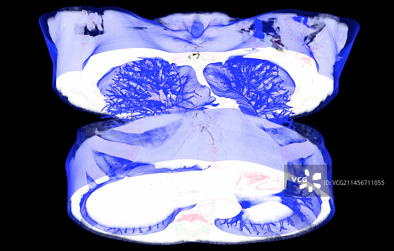 主动脉动脉瘤3D CT扫描图片素材