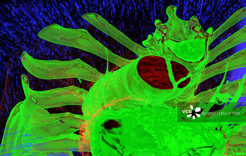 主动脉动脉瘤3D CT扫描图片素材