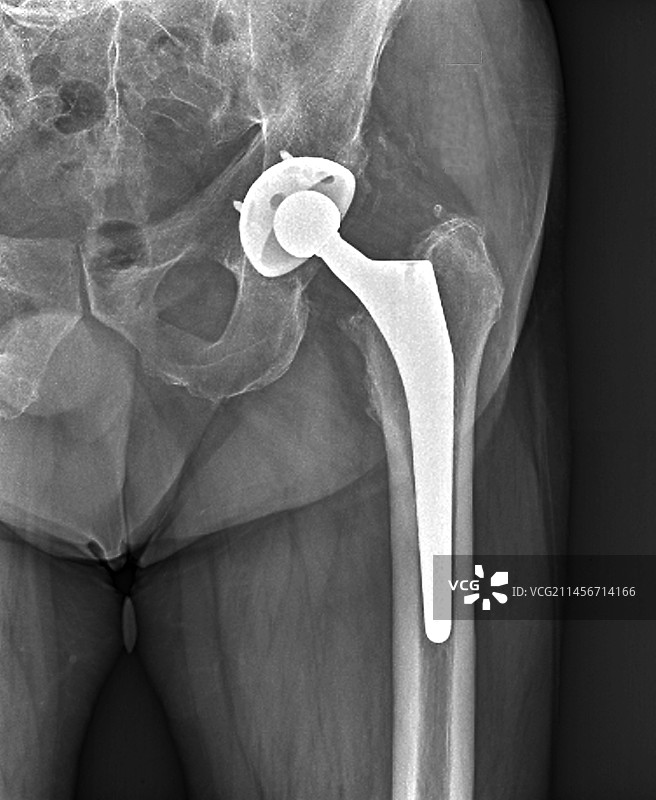 全髋关节置换X光片图片素材