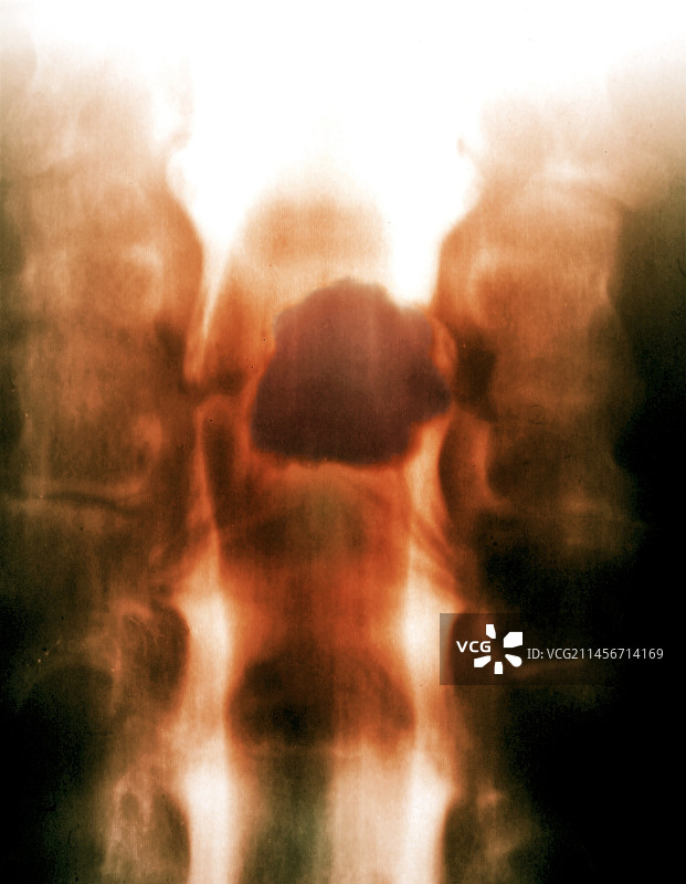 脊髓肿瘤X光片图片素材