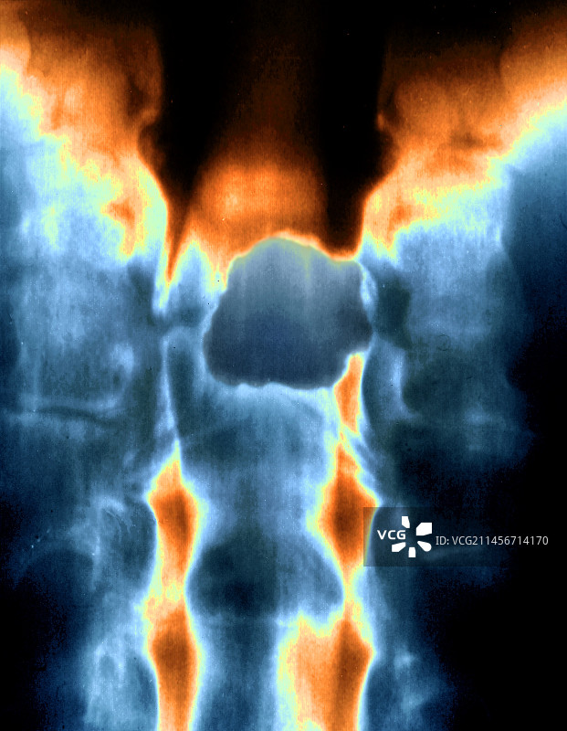 脊髓肿瘤X光片图片素材