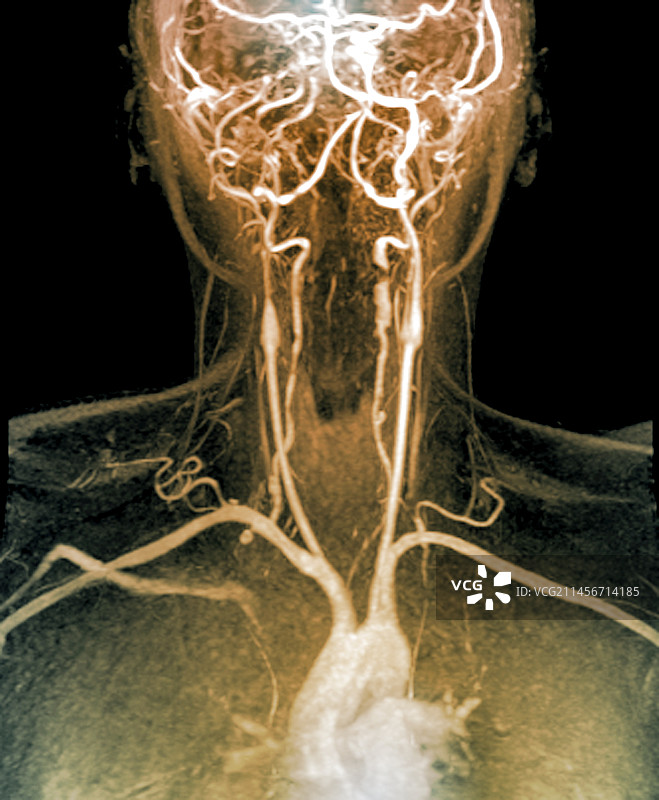 颈动脉剥离核磁共振血管造影图片素材