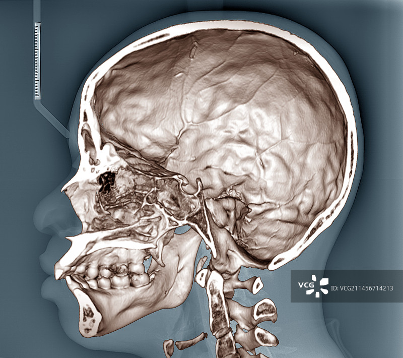 人类头骨3D CT扫描图片素材