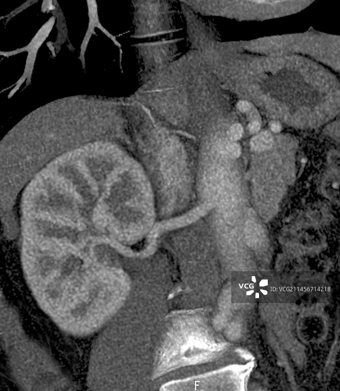 马凡氏综合征中的肾脏，CT扫描图片素材