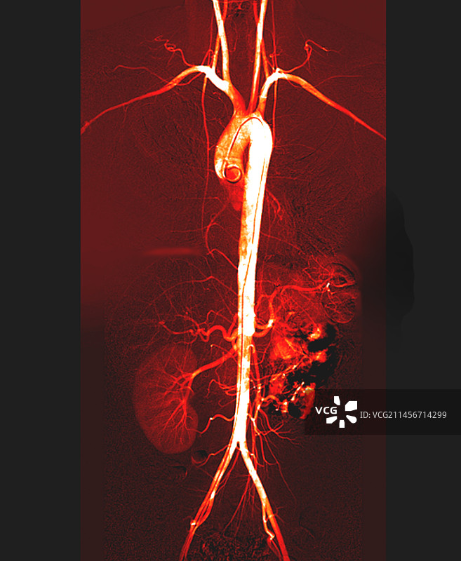躯干动脉数字血管造影图片素材