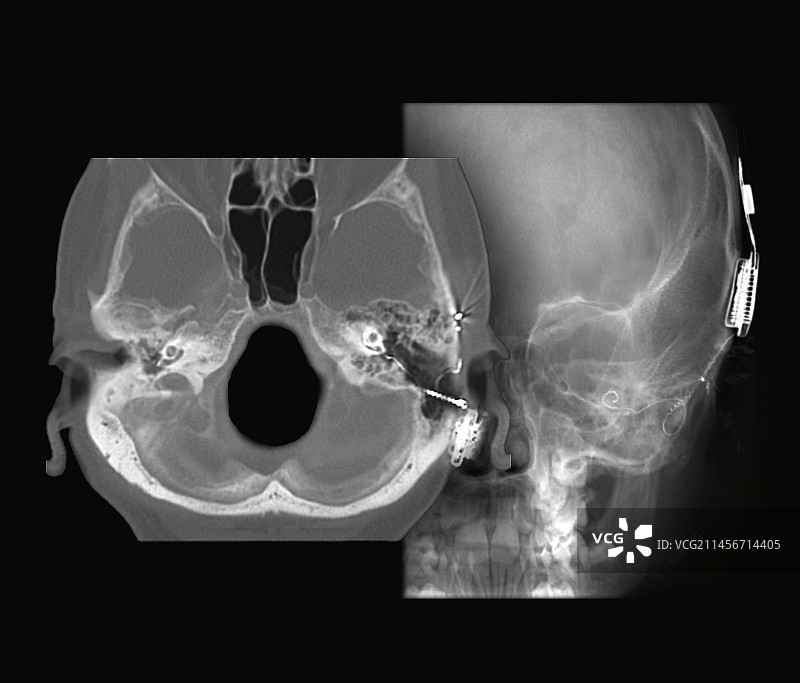 人工耳蜗、CT扫描和X光片图片素材