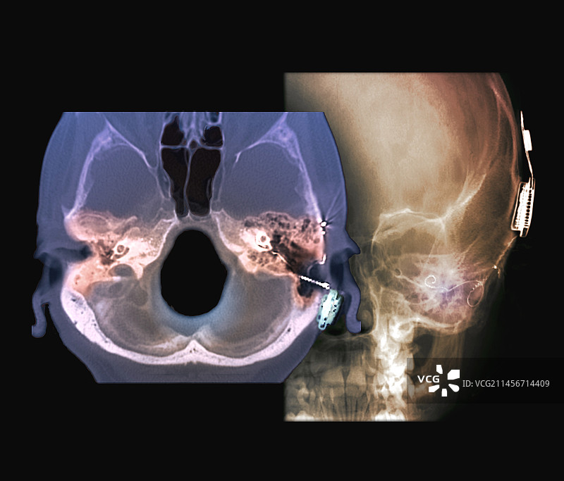 人工耳蜗、CT扫描和X光片图片素材