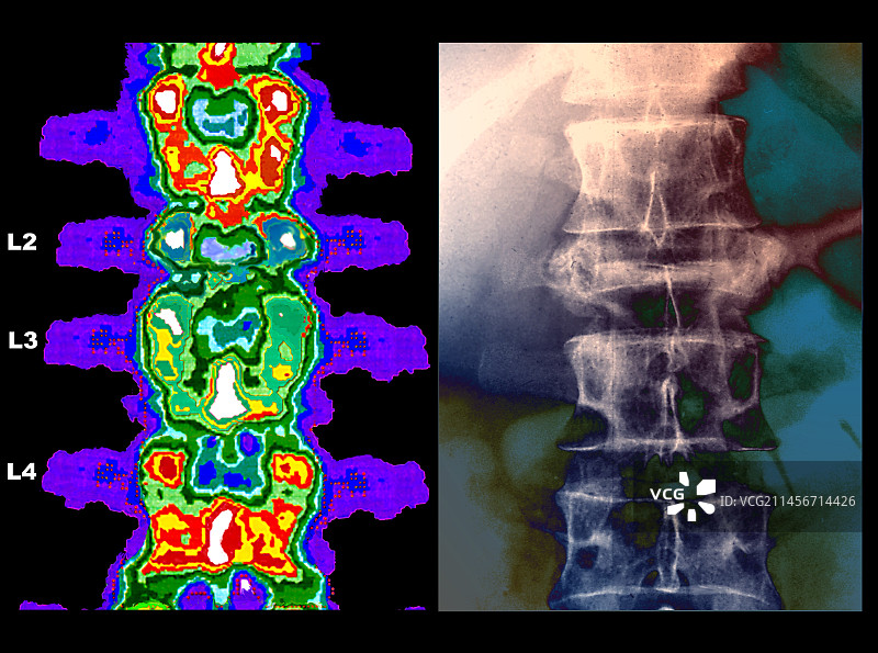 骨骼脱矿质、骨密度扫描和X光图片素材