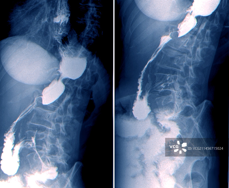 食道癌X光片图片素材