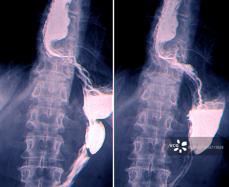 食道癌X光片图片素材