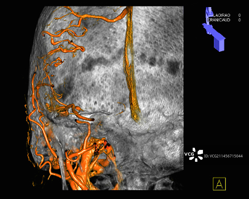 动脉畸形3D CT扫描图图片素材