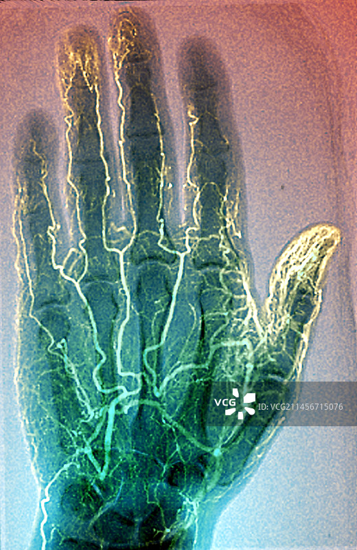 糖尿病性动脉炎X光片图片素材