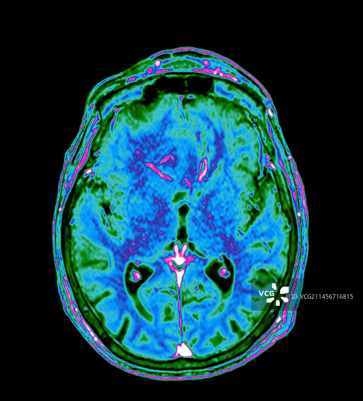 脑膜瘤脑肿瘤MRI图片素材