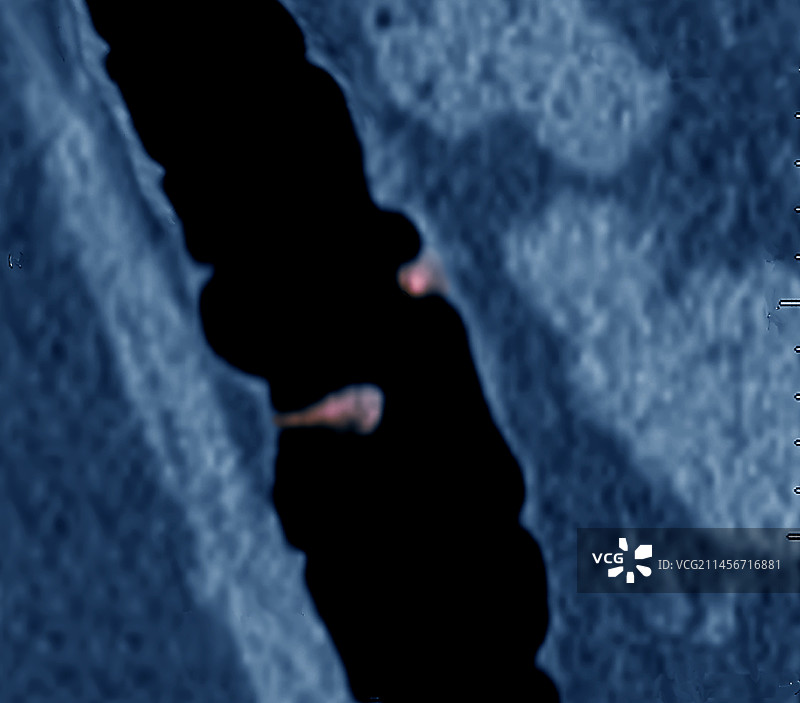 结直肠息肉CT扫描图图片素材