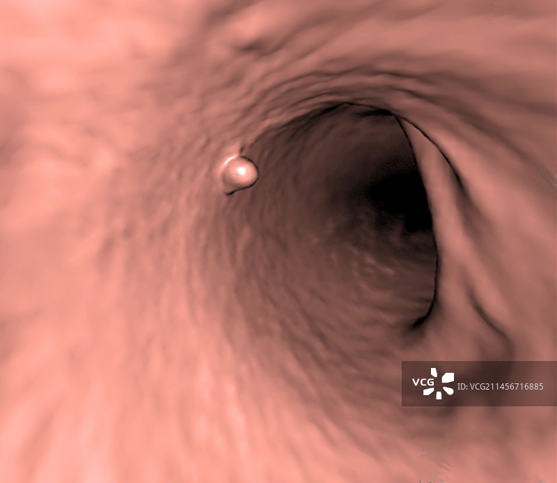 结直肠息肉3D CT扫描图片素材