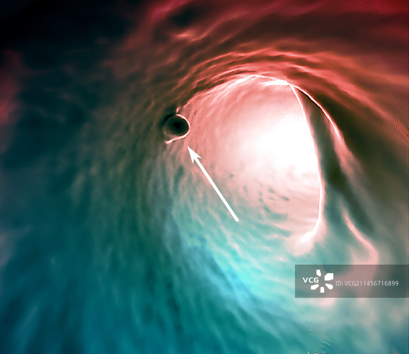 结直肠息肉3D CT扫描图片素材