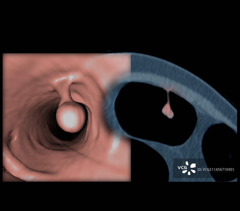 结直肠息肉CT扫描图图片素材