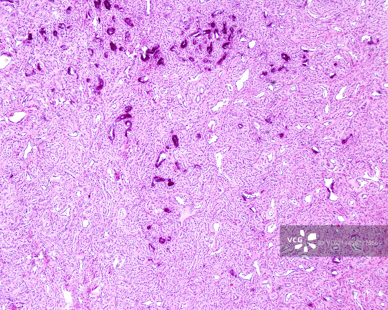 血管内皮瘤显微照片图片素材