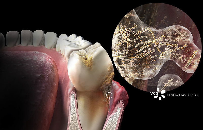 牙齿上的牙菌斑形成示意图图片素材