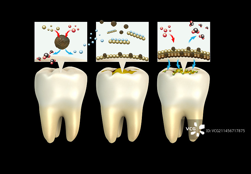 牙菌斑形成示意图图片素材