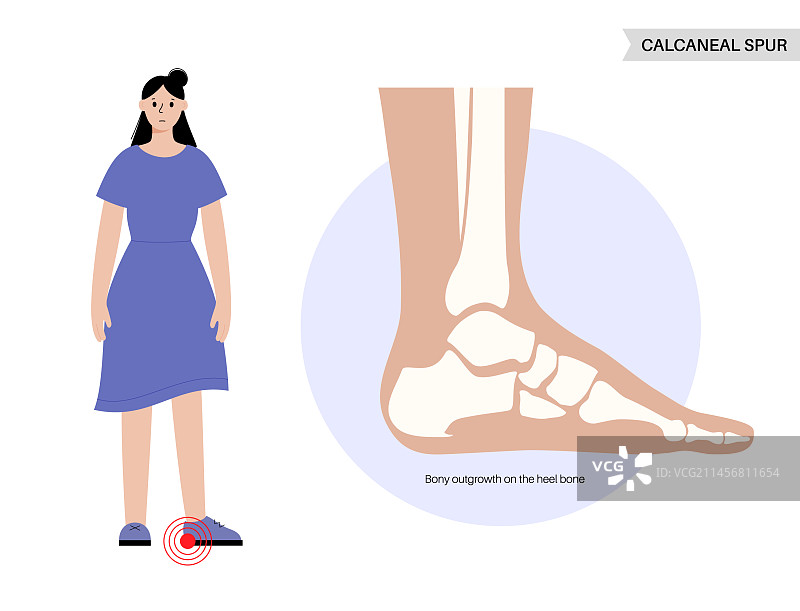 足跟骨刺海报图片素材
