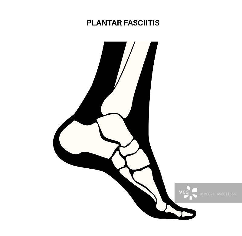 足底筋膜炎概念图片素材
