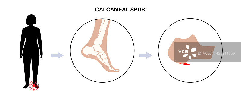 足跟骨刺海报图片素材