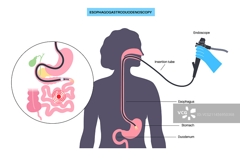 食管胃十二指肠镜检查医疗程序图片素材
