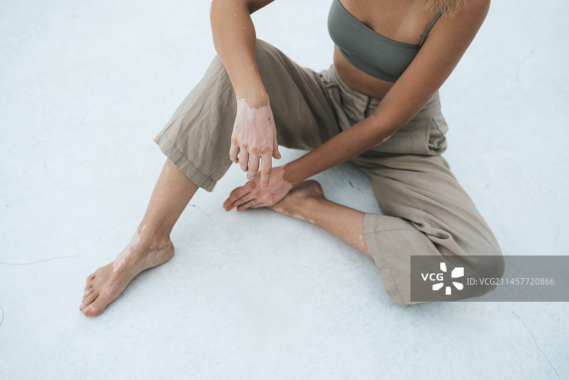 患有白癜风的女性身体，泰国帕岸岛图片素材