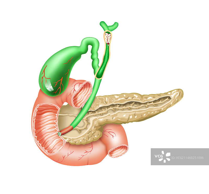 胆总管上段结石图片素材