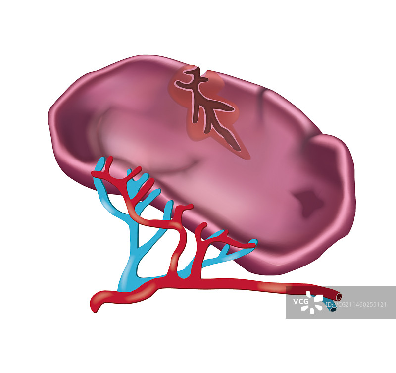 脾破裂图片素材
