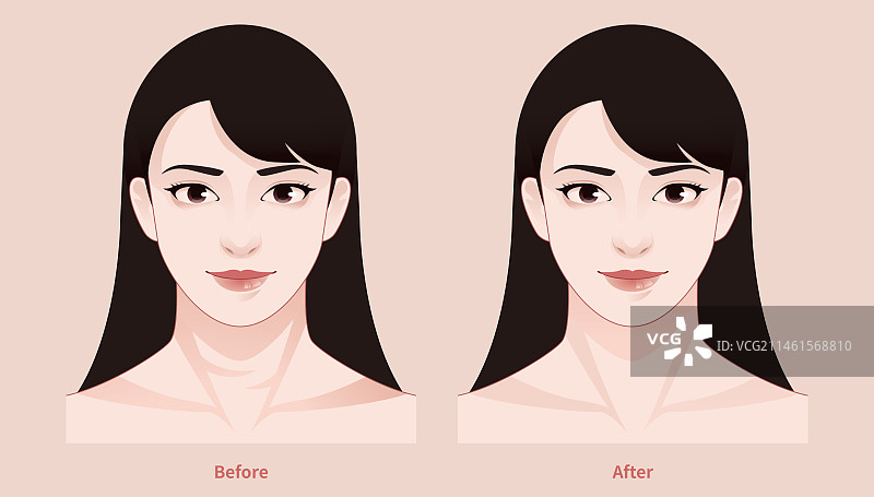 颈纹 整容案例 人物图片素材