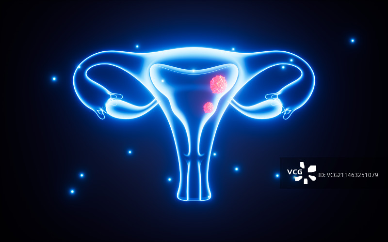 子宫病变子宫癌概念图3D渲染图片素材