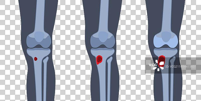 胫骨骨髓炎图片素材