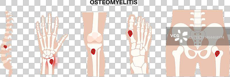 骨髓炎疾病海报图片素材