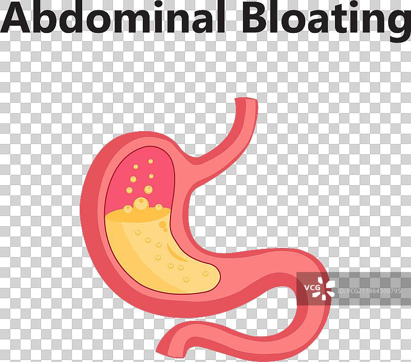 胃食管反流病图片素材