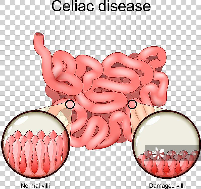 乳糜泻小肠横截面图片素材