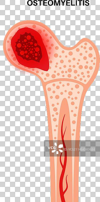 髋部骨髓炎图片素材