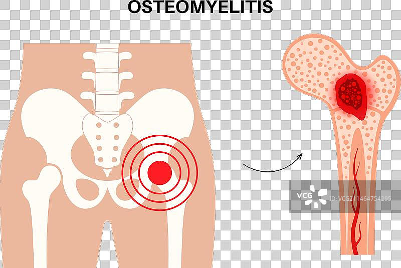 髋部骨髓炎图片素材