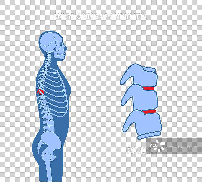 强直性脊柱炎疾病图片素材